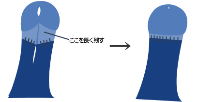 亀頭直下切除法