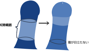 陰茎根部切除法